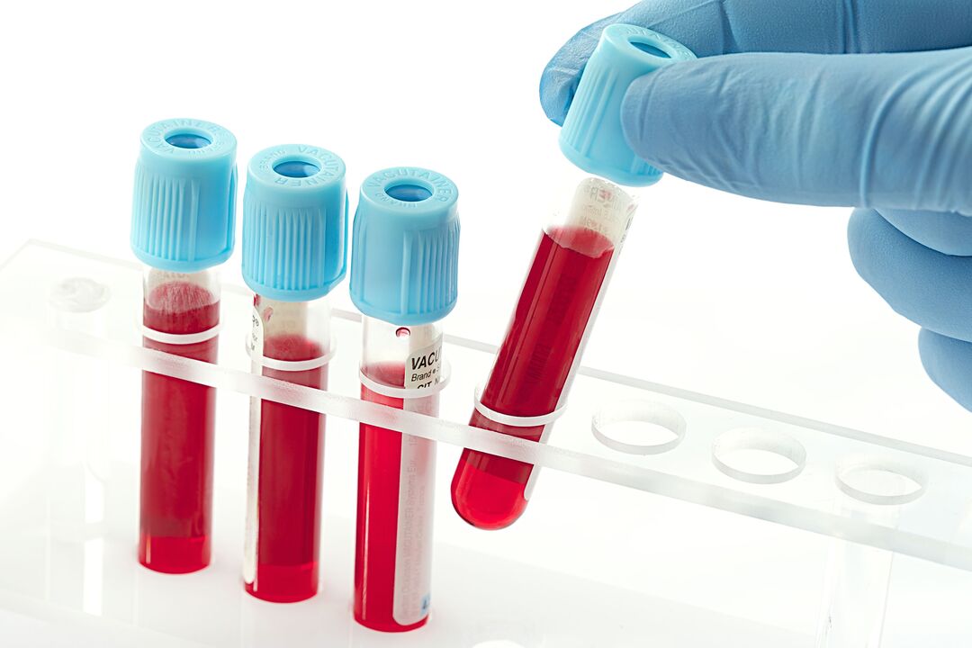 فحص الدم لتشخيص فيروس الورم الحليمي البشري