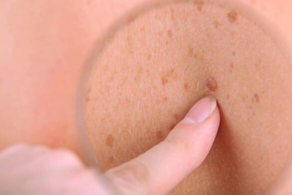 الأورام الحليمية على جلد الإنسان